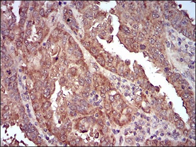 Figure 5: Immunohistochemical analysis of paraffin-embedded endometrial cancer tissues using CAV2 mouse mAb with DAB staining.