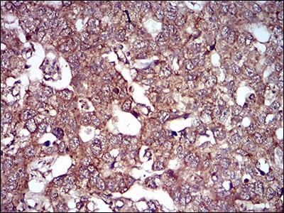 Figure 6: Immunohistochemical analysis of paraffin-embedded esophageal cancer tissues using CAV2 mouse mAb with DAB staining.