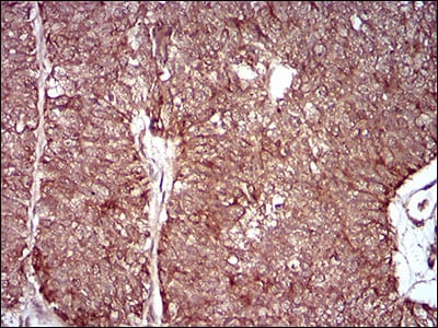 Figure 4: Immunohistochemical analysis of paraffin-embedded ovarian cancer tissues using MMEL1 mouse mAb with DAB staining.