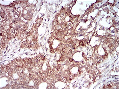 Figure 5: Immunohistochemical analysis of paraffin-embedded cervical cancer tissues using MMEL1 mouse mAb with DAB staining.