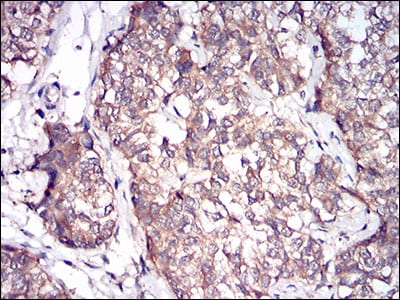 Figure 6: Immunohistochemical analysis of paraffin-embedded bladder cancer tissues using PRL mouse mAb with DAB staining.