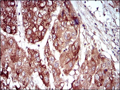 Figure 5: Immunohistochemical analysis of paraffin-embedded liver cancer tissues using MAP2K5 mouse mAb with DAB staining.