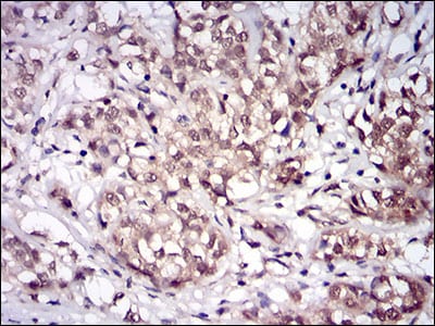 Figure 6: Immunohistochemical analysis of paraffin-embedded bladder cancer tissues using PPP1CB mouse mAb with DAB staining.