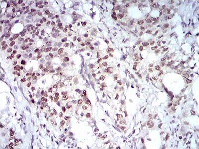 Figure 3: Immunohistochemical analysis of paraffin-embedded cervical cancer tissues using MAPK7 mouse mAb with DAB staining.