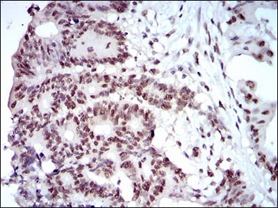 Figure 4: Immunohistochemical analysis of paraffin-embedded colon cancer tissues using MAPK7 mouse mAb with DAB staining.