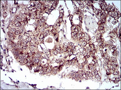 Figure 5: Immunohistochemical analysis of paraffin-embedded esophageal cancer tissues using PDK2 mouse mAb with DAB staining.