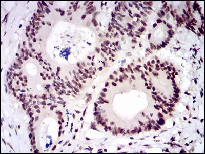 Figure 6: Immunohistochemical analysis of paraffin-embedded colon cancer tissues using CTNNBL1 mouse mAb with DAB staining.