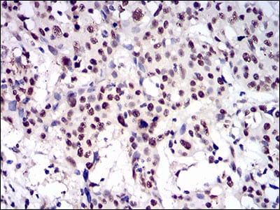 Figure 7: Immunohistochemical analysis of paraffin-embedded esophageal cancer tissues using CTNNBL1 mouse mAb with DAB staining.