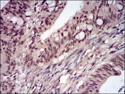 Figure 7: Immunohistochemical analysis of paraffin-embedded rectum cancer tissues using PPP1CB mouse mAb with DAB staining.