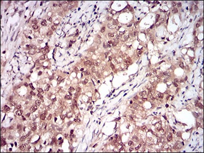 Figure 5: Immunohistochemical analysis of paraffin-embedded cervical cancer tissues using RELB mouse mAb with DAB staining.