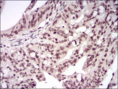 Figure 6: Immunohistochemical analysis of paraffin-embedded rectum cancer tissues using RELB mouse mAb with DAB staining.