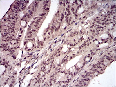 Figure 4: Immunohistochemical analysis of paraffin-embedded rectum cancer tissues using CCNE1 mouse mAb with DAB staining.