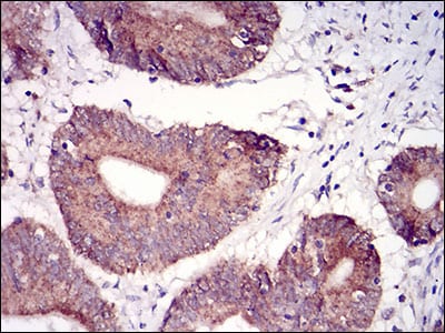 Figure 4: Immunohistochemical analysis of paraffin-embedded colon cancer tissues using TUBE1 mouse mAb with DAB staining.