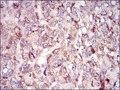 Figure 5: Immunohistochemical analysis of paraffin-embedded liver cancer tissues using TUBE1 mouse mAb with DAB staining.