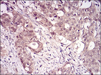 Figure 5: Immunohistochemical analysis of paraffin-embedded cervical cancer tissues using RANBP9 mouse mAb with DAB staining.