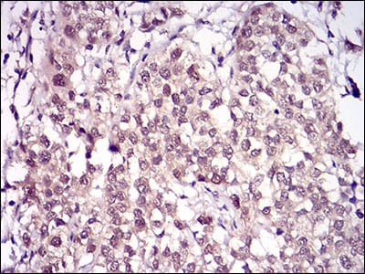 Figure 6: Immunohistochemical analysis of paraffin-embedded bladder cancer tissues using RANBP9 mouse mAb with DAB staining.