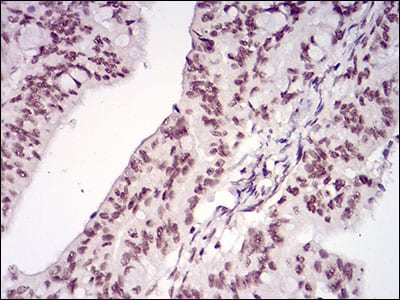 Figure 4: Immunohistochemical analysis of paraffin-embedded rectum cancer tissues using MEN1 mouse mAb with DAB staining.