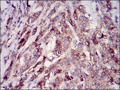 Figure 3: Immunohistochemical analysis of paraffin-embedded prostate cancer tissues using RAB27A mouse mAb with DAB staining.