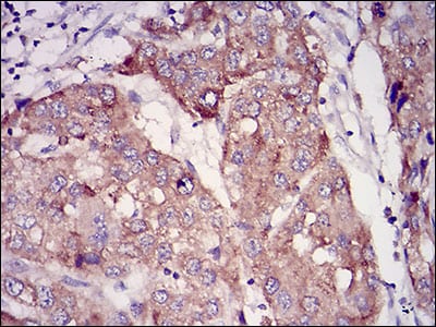 Figure 4: Immunohistochemical analysis of paraffin-embedded liver cancer tissues using RAB27A mouse mAb with DAB staining.