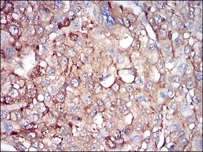 Figure 5: Immunohistochemical analysis of paraffin-embedded liver cancer tissues using FTL mouse mAb with DAB staining.