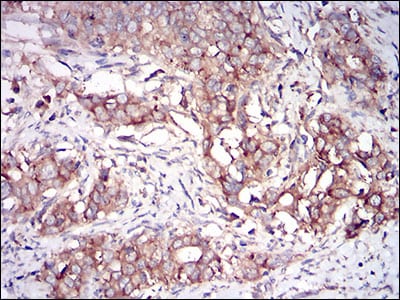 Figure 5: Immunohistochemical analysis of paraffin-embedded cervical cancer tissues using EIF2AK2 mouse mAb with DAB staining.