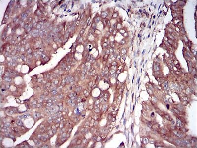 Figure 6: Immunohistochemical analysis of paraffin-embedded rectum cancer tissues using EIF2AK2 mouse mAb with DAB staining.