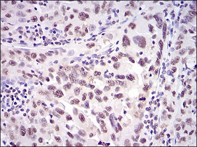 Figure 6: Immunohistochemical analysis of paraffin-embedded endometrial cancer tissues using XRCC6 mouse mAb with DAB staining.