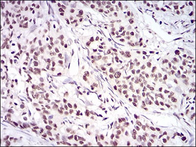 Figure 7: Immunohistochemical analysis of paraffin-embedded cervical cancer tissues using XRCC6 mouse mAb with DAB staining.