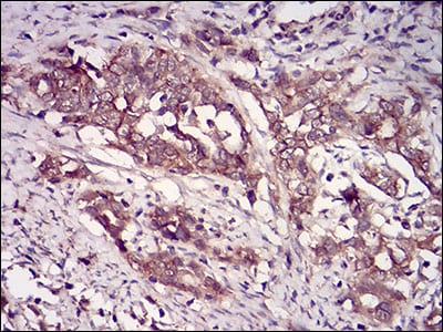 Figure 6: Immunohistochemical analysis of paraffin-embedded cervical cancer tissues using CSNK2B mouse mAb with DAB staining.