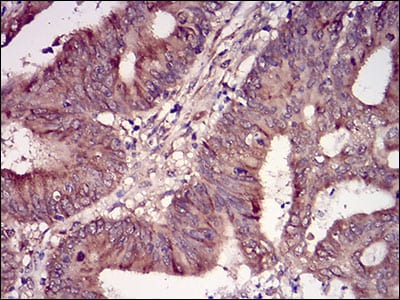 Figure 7: Immunohistochemical analysis of paraffin-embedded colon cancer tissues using CSNK2B mouse mAb with DAB staining.