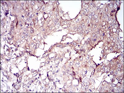 Figure 4: Immunohistochemical analysis of paraffin-embedded stomach cancer tissues using VIL1 mouse mAb with DAB staining.