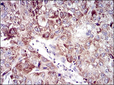 Figure 3: Immunohistochemical analysis of paraffin-embedded liver cancer tissues using UBE2C mouse mAb with DAB staining.