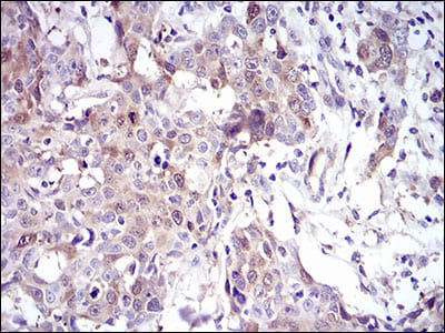 Figure 4: Immunohistochemical analysis of paraffin-embedded esophageal cancer tissues using UBE2C mouse mAb with DAB staining.