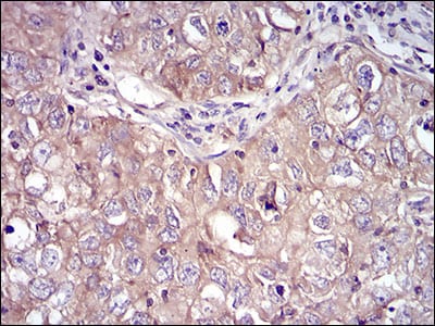 Figure 7: Immunohistochemical analysis of paraffin-embedded lung cancer tissues using RPS6KA2 mouse mAb with DAB staining.