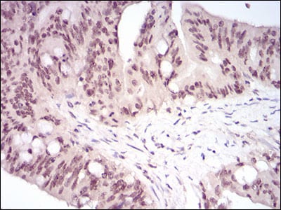 Figure 4: Immunohistochemical analysis of paraffin-embedded rectum cancer tissues using HSF1 mouse mAb with DAB staining.