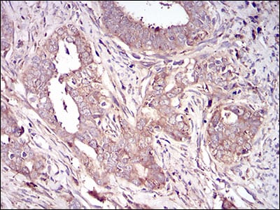 Figure 4: Immunohistochemical analysis of paraffin-embedded cervical cancer tissues using VTN mouse mAb with DAB staining.