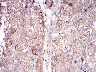 Figure 5: Immunohistochemical analysis of paraffin-embedded liver cancer tissues using VTN mouse mAb with DAB staining.