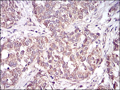 Figure 3: Immunohistochemical analysis of paraffin-embedded bladder cancer tissues using CD36 mouse mAb with DAB staining.
