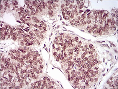Figure 5: Immunohistochemical analysis of paraffin-embedded ovarian cancer tissues using PER3 mouse mAb with DAB staining.