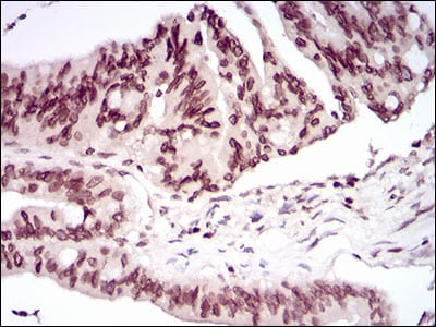 Figure 6: Immunohistochemical analysis of paraffin-embedded rectum cancer tissues using PER3 mouse mAb with DAB staining.