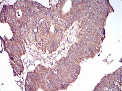 Figure 3: Immunohistochemical analysis of paraffin-embedded rectum cancer tissues using GSK3B mouse mAb with DAB staining.