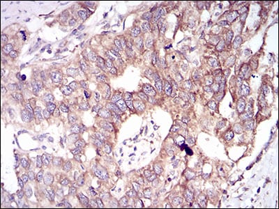 Figure 4: Immunohistochemical analysis of paraffin-embedded esophageal cancer tissues using GSK3B mouse mAb with DAB staining.