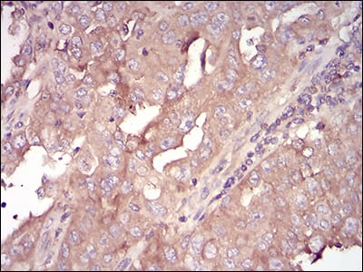Figure 5: Immunohistochemical analysis of paraffin-embedded endometrial cancer tissues using SERPINA3 mouse mAb with DAB staining.