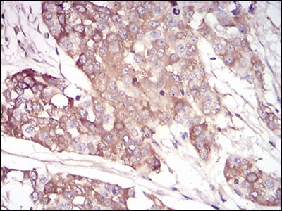 Figure 6: Immunohistochemical analysis of paraffin-embedded bladder cancer tissues using SERPINA3 mouse mAb with DAB staining.