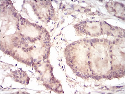 Figure 5: Immunohistochemical analysis of paraffin-embedded colon cancer tissues using EIF5A mouse mAb with DAB staining.