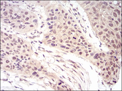 Figure 6: Immunohistochemical analysis of paraffin-embedded esophageal cancer tissues using EIF5A mouse mAb with DAB staining.