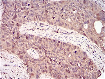 Figure 5: Immunohistochemical analysis of paraffin-embedded cervical cancer tissues using CCNA2 mouse mAb with DAB staining.