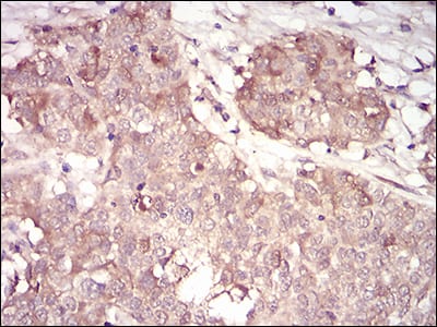 Figure 6: Immunohistochemical analysis of paraffin-embedded bladder cancer tissues using CCNA2 mouse mAb with DAB staining.