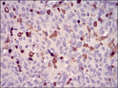 Figure 4: Immunohistochemical analysis of paraffin-embedded ovarian cancer tissues using WAS mouse mAb with DAB staining.