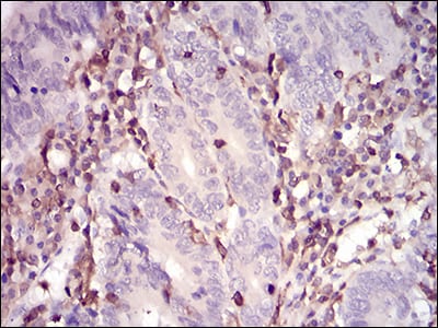 Figure 5: Immunohistochemical analysis of paraffin-embedded colon cancer tissues using WAS mouse mAb with DAB staining.
